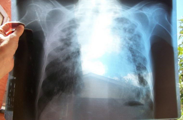 Qatar-Sees-Sharp-Increase-In-TB-Cases-HMC